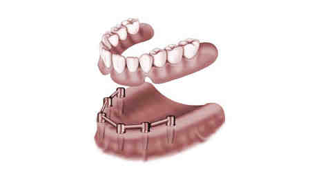 How much does a dental implant cost with insurance?