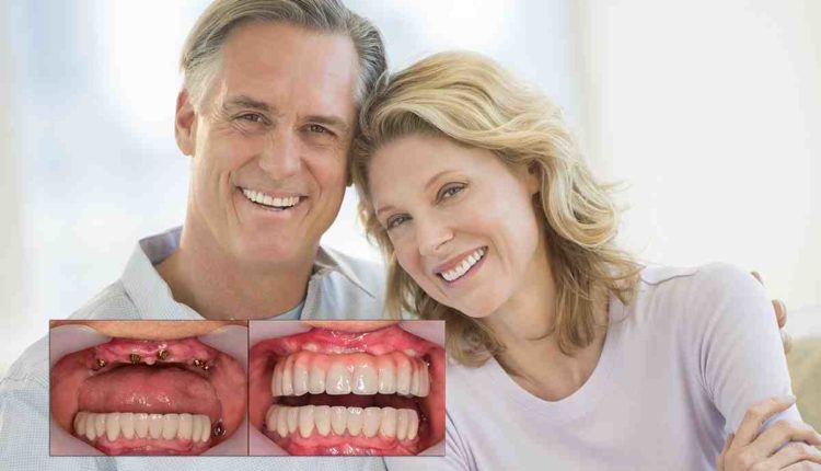How much does a full dental implants cost