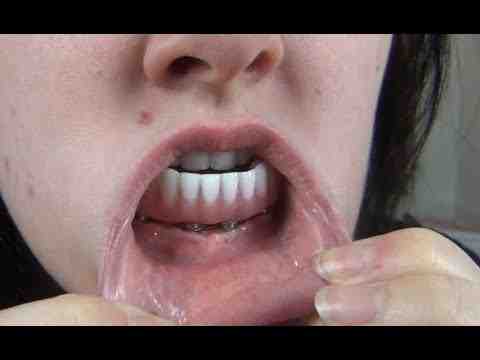 How much does a full mouth of dental implants cost?