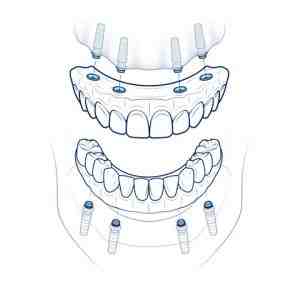 How much does a full set of dental implants cost at Clear Choice?