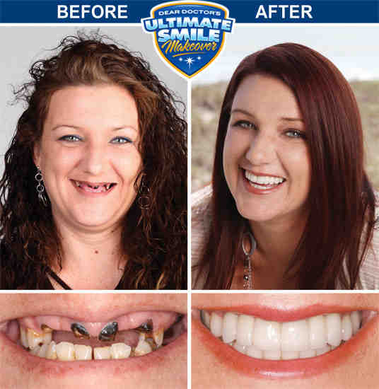 How much does a smile makeover cost?