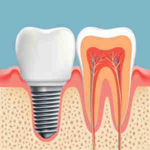 How much does an implant cost with insurance?