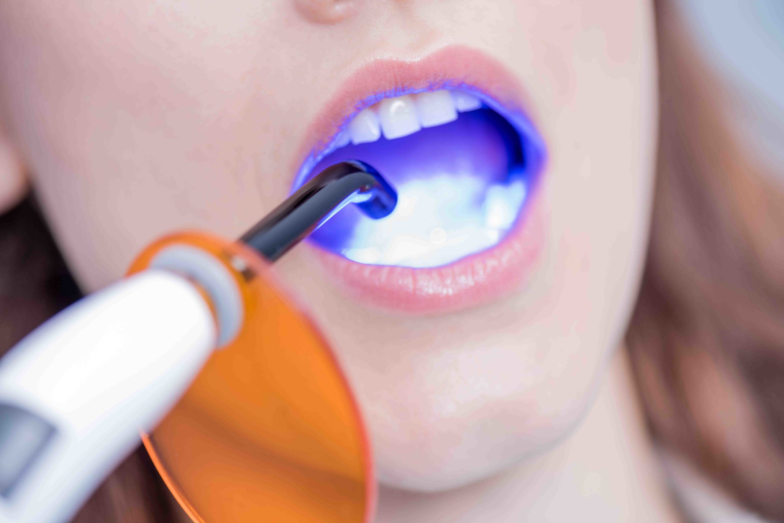 Cosmetic dentistry resin composite Dental News Network