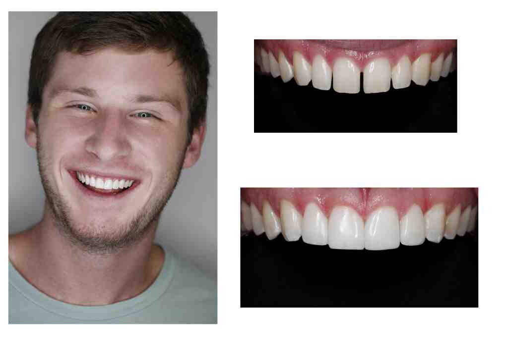 How much does cosmetic bonding cost?