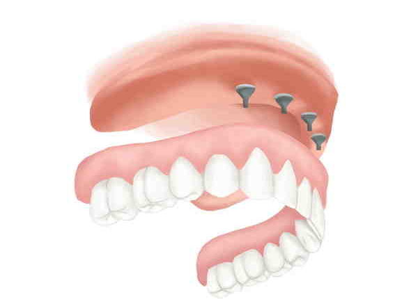 How much does delta dental pay for implants