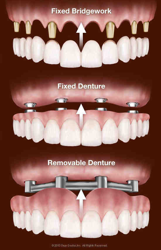 How much does it cost to get a full mouth of implants?