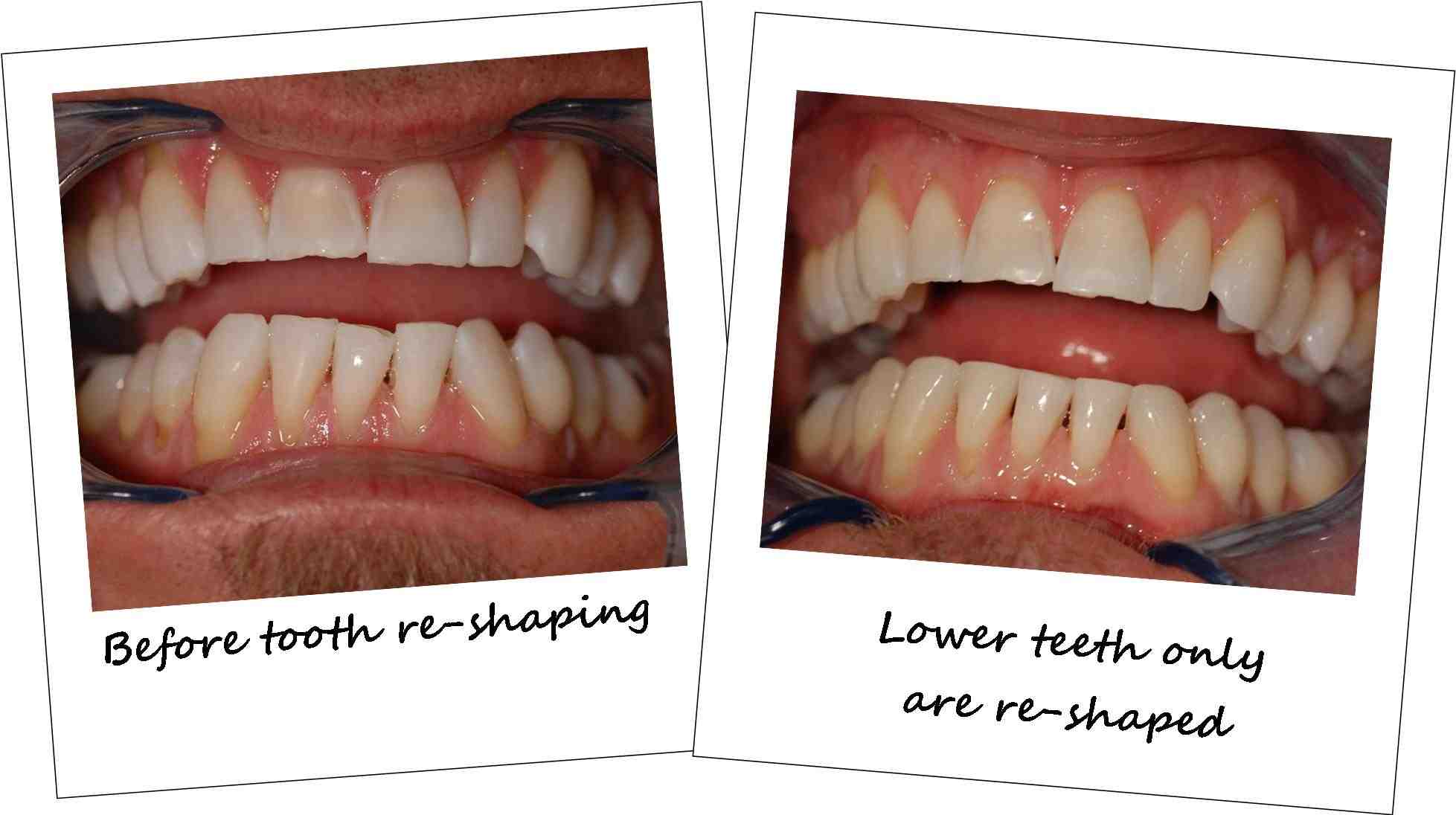 How much does it cost to put veneers on all teeth?