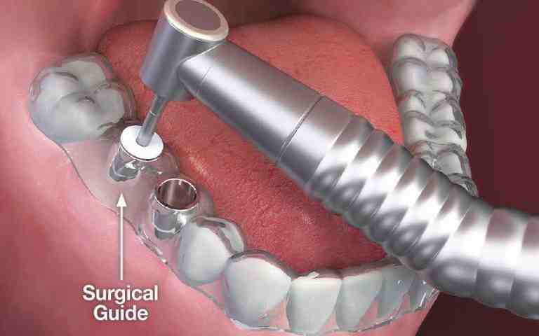 How much does it cost to replace all top teeth?