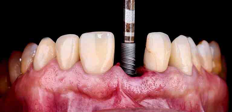 How much does single dental implant cost?