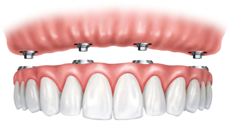 How much is a dental implant in india