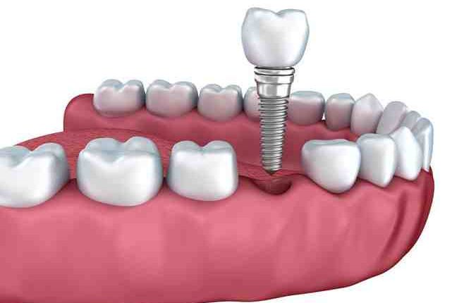 How much is dental implant crown