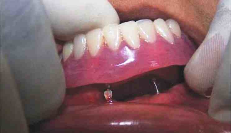 How much is mini dental implants