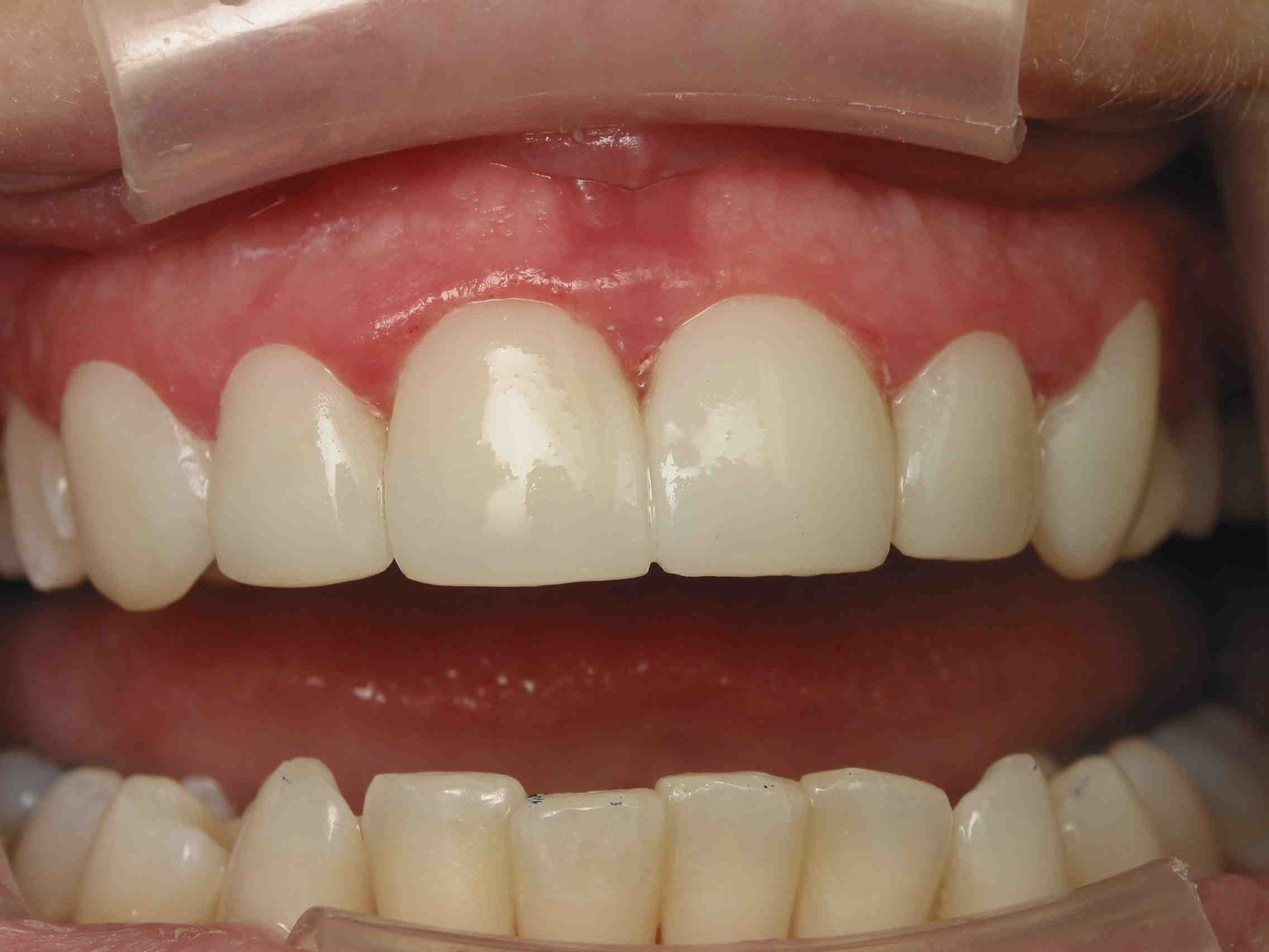 How much is teeth contouring and bonding?