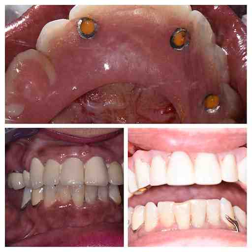 How much should dental implants cost in 2020?