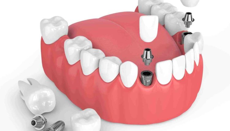 How painful is it to get dental implants?