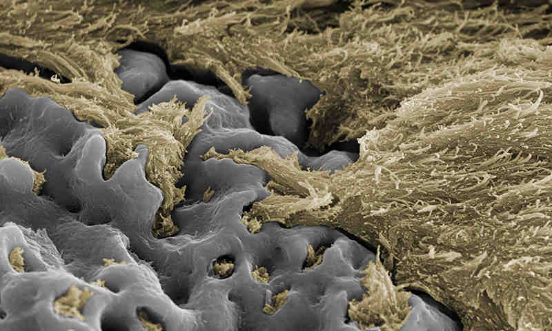 Is Nobel Biocare the best implant?