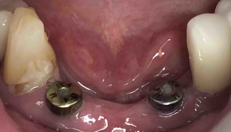 Is a dental implant procedure painful and is there much pain after the procedure