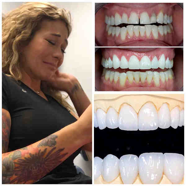 Is a smile makeover worth it?