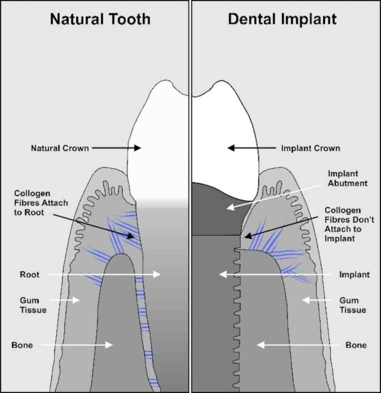 How are abutments attached to dental implants? Dental News Network