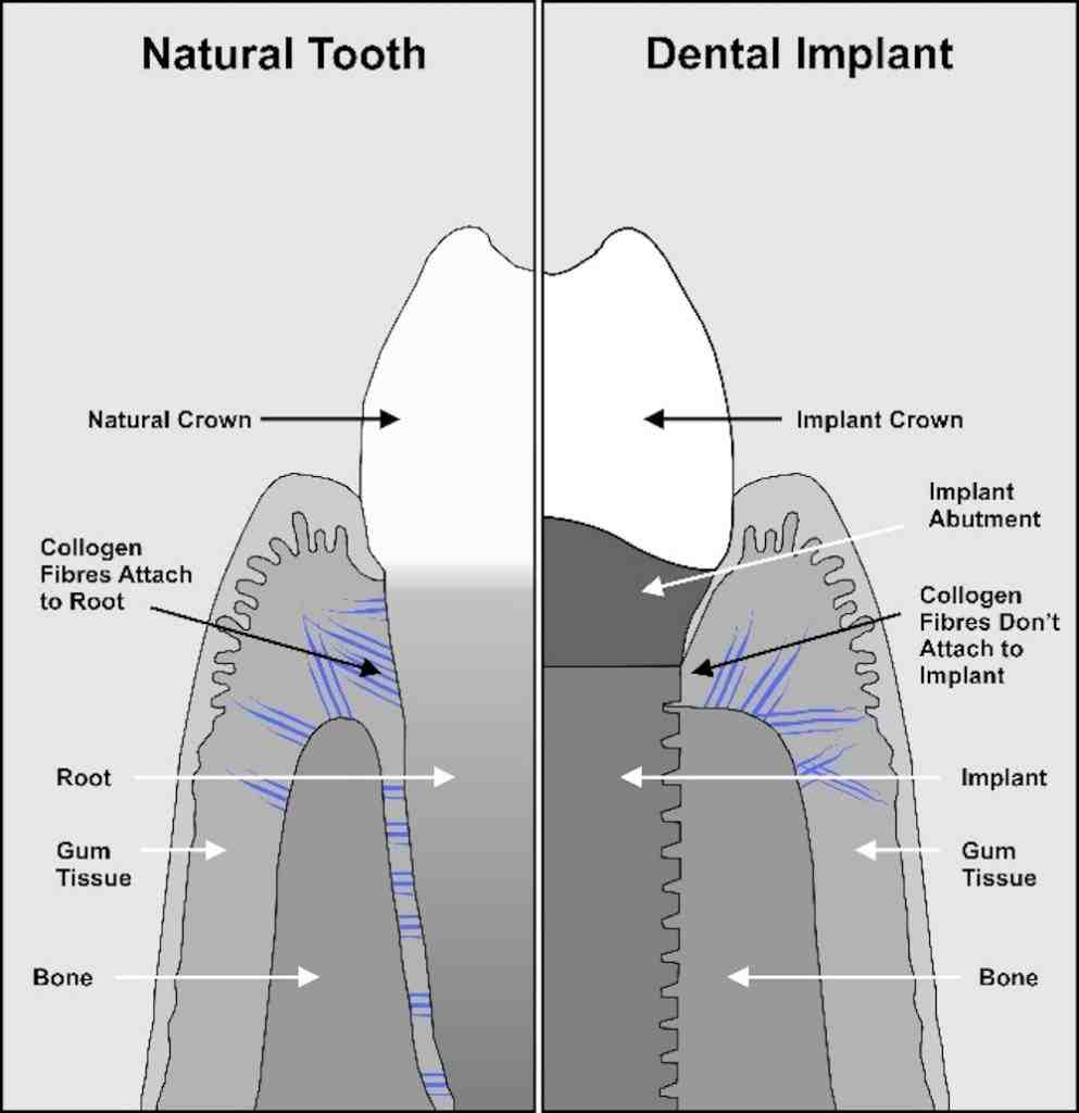 Is dental implant abutment painful?