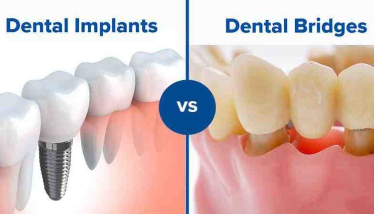 Is Dental Implants Covered By Insurance - Dental News Network