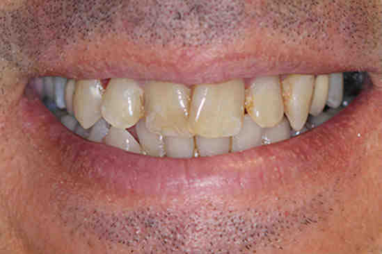 Is it cheaper to get multiple dental implants at once?