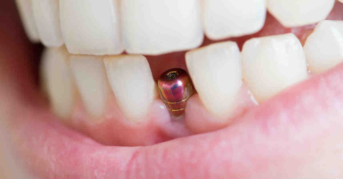 Is it ever too late to get dental implants?