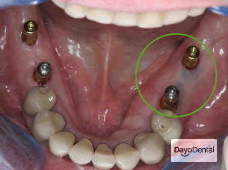 Is it safe to get dental implants in Mexico?