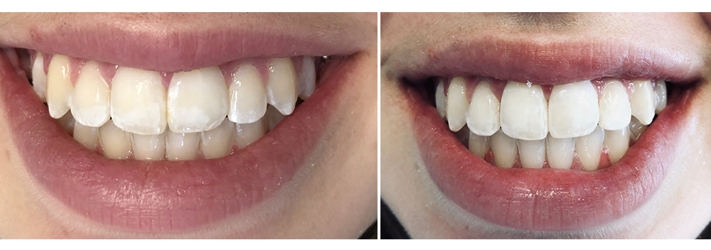 Is the first visit at Aspen Dental free?