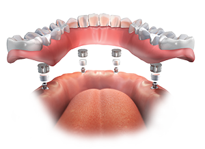Is there a time limit on dental implants?