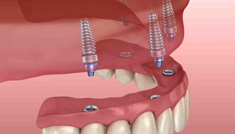 Is there any dental insurance that helps cover mini implants