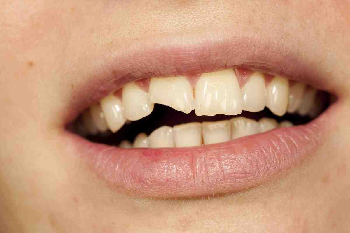 Should I be able to feel dental implants?