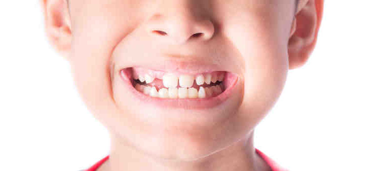 What age can you get a dental implant