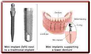 What are the 3 stages of dental implants?