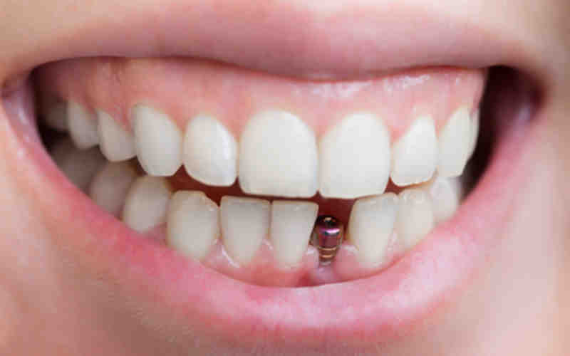 What are the different types of teeth implants?