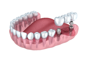 What are the three main types of dental implants?