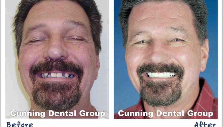 What dental implants cost