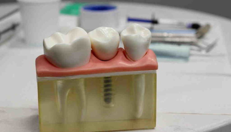 What dental specialty does implants