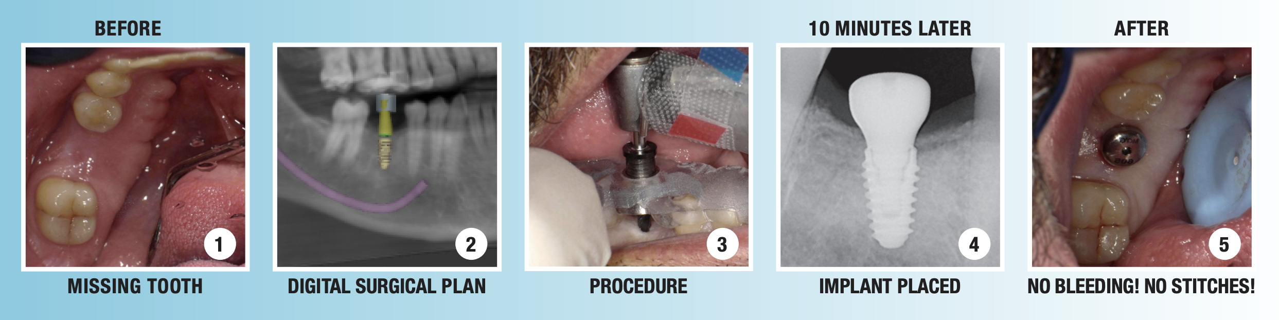 What is the dental implant process Dental News Network