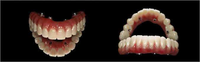 What happens after full mouth dental implants?