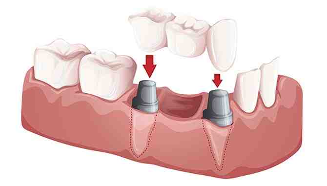 What happens if you don't get an implant after tooth extraction?