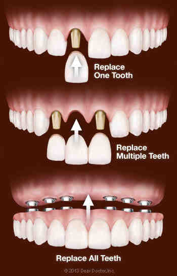 What happens if you don't get tooth implant?