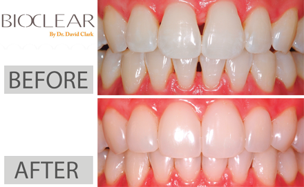 What happens to veneers after 10 years?