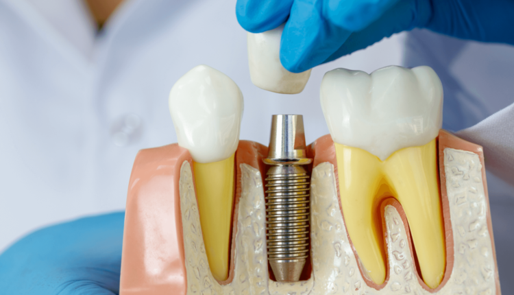 What if you don't have enough bone for dental implants