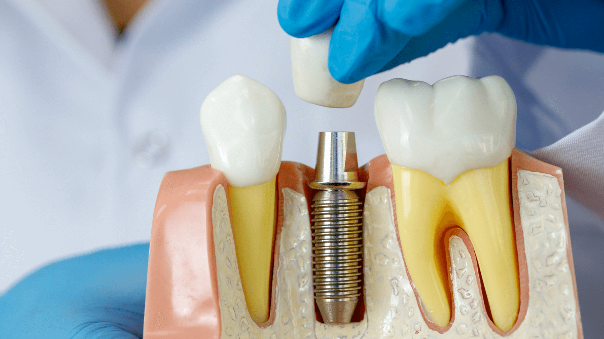 What If You Don t Have Enough Bone For Dental Implants Dental News 