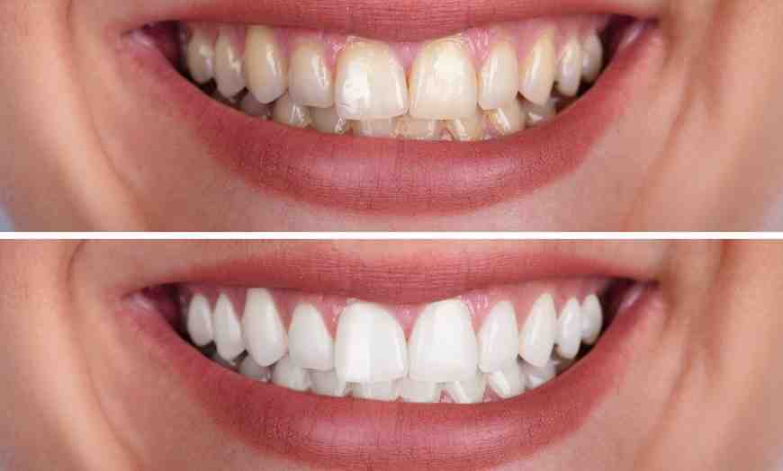 What is a reasonable price for dental implants?