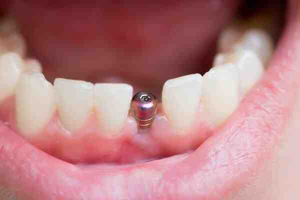 What is a reasonable price for dental implants?