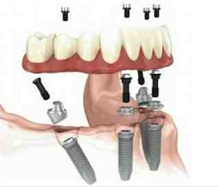 What is a reasonable price for dental implants?
