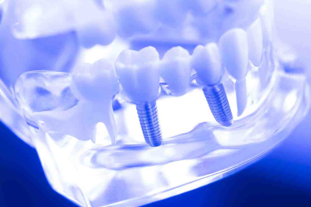 What is a reasonable price for dental implants?