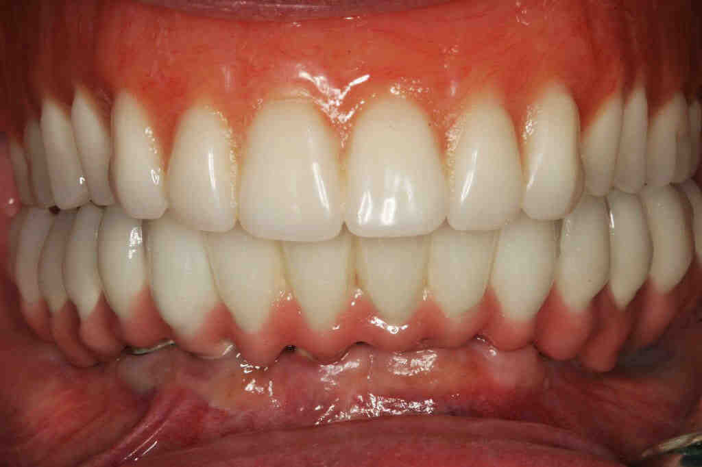What is a reasonable price for dental implants?